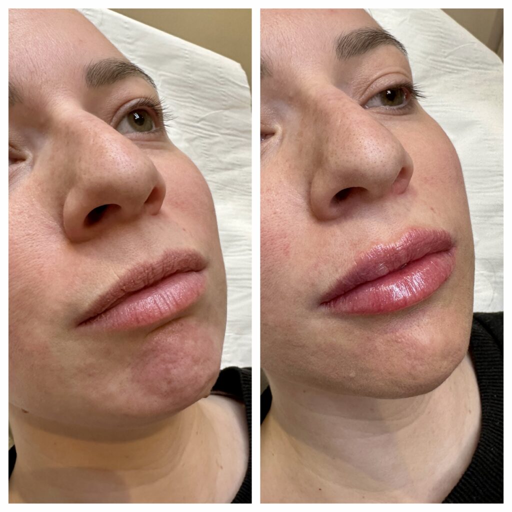 Lips & Chin Augmentation